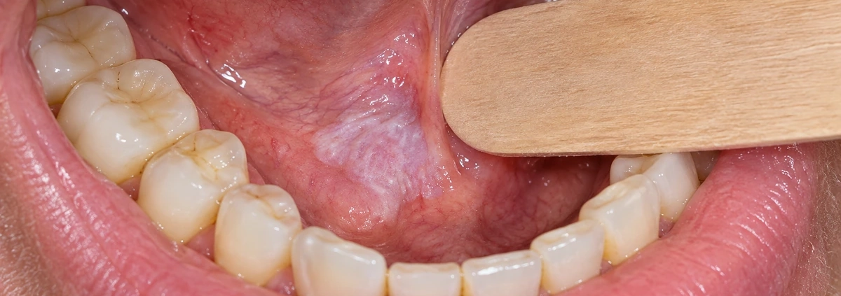 Leucoplachia del cavo orale: placca bianca sulla mucosa orale