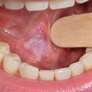Leucoplachia del cavo orale: placca bianca sulla mucosa orale