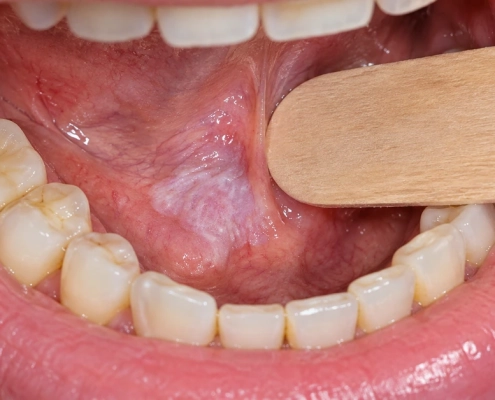 Leucoplachia del cavo orale: placca bianca sulla mucosa orale