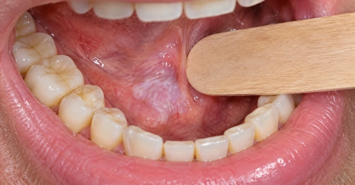 Leucoplachia del cavo orale: placca bianca sulla mucosa orale