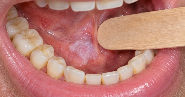 Leucoplachia del cavo orale: placca bianca sulla mucosa orale