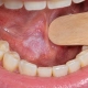 Leucoplachia del cavo orale: placca bianca sulla mucosa orale